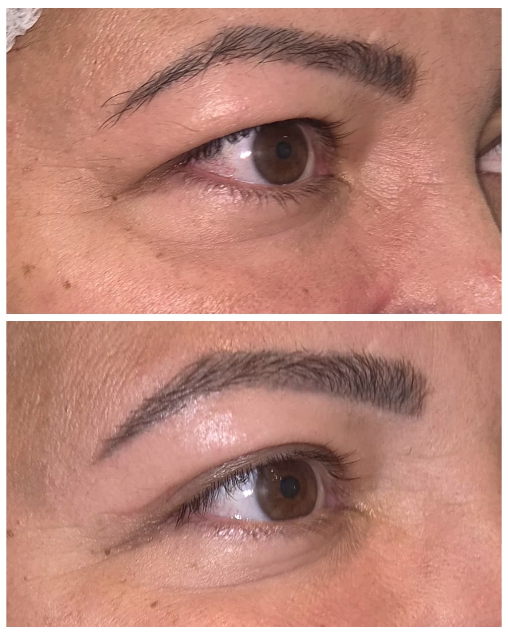 Antes e depois de blefaroplastia 15